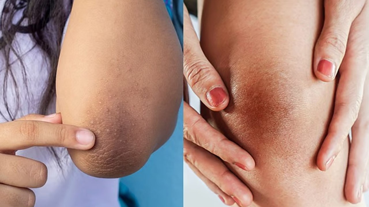 முழங்கை கருமையால் கவலைப்படுபவரா நீங்க?